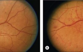 6b 6a retinopathy diabetic beading venous airlie house standard