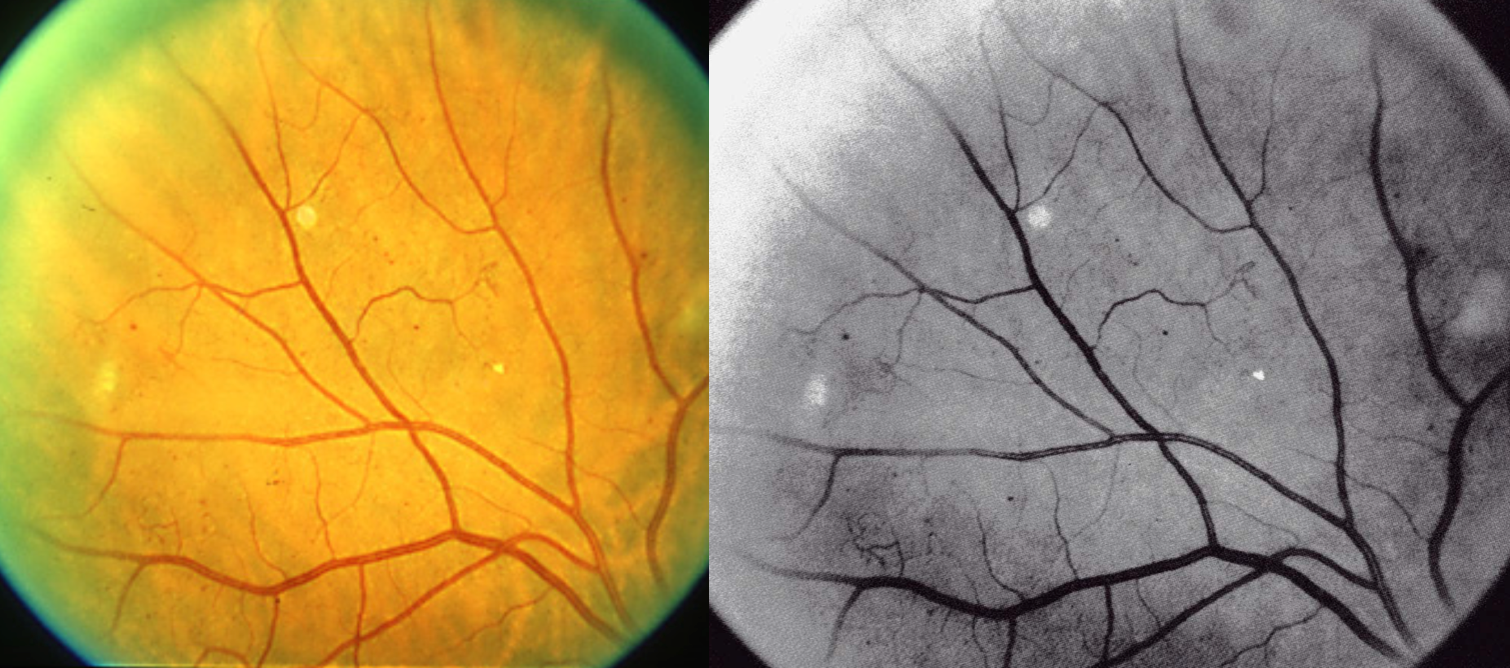 Сетчатки обоих глаз. Плаквенил ретинопатия. Ретинопатия соль с перцем. Ангиосклероз сетчатки витамины.