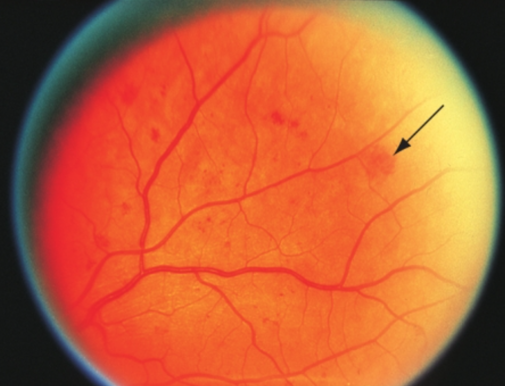 Воспаление сетчатки. Паранеопластическая ретинопатия.