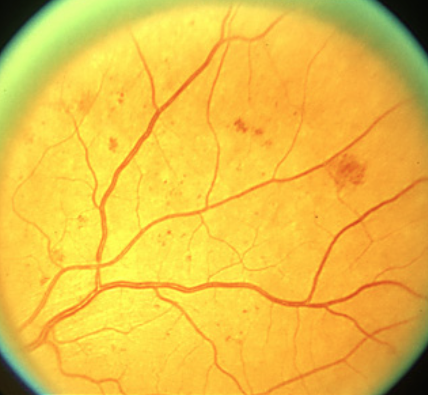 Диабетическая ретинопатия глазное дно. Микроаневризмы сетчатки. Ангиопатия сетчатки глазное дно. ETDRS диабетическая ретинопатия. Сетчатки по гипертоническому типу