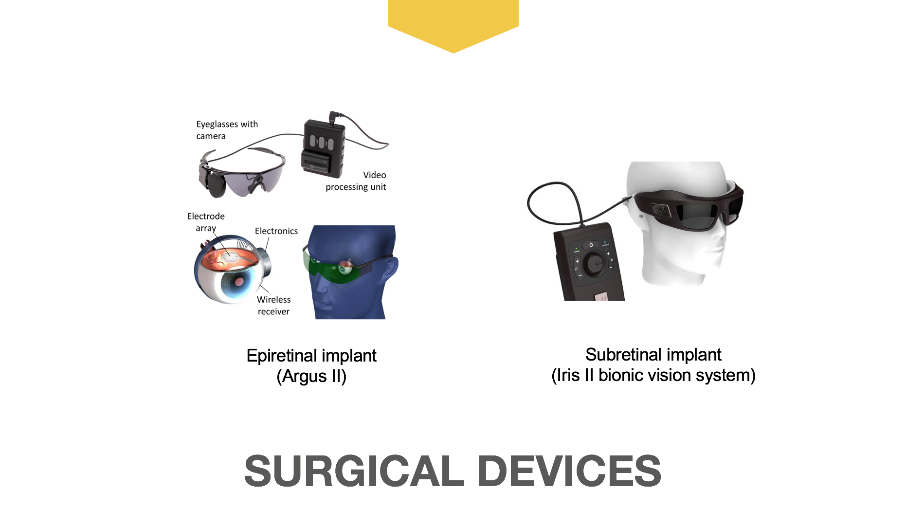 Argus II epiretinal implant and Iris II bionic vision system subretinal implant
